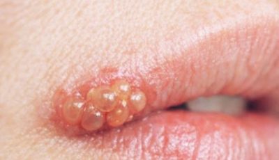 My sister developed this painful bubbling blister on her lip right before her wedding. She is freaking out and needs it gone immediately. Any tips?