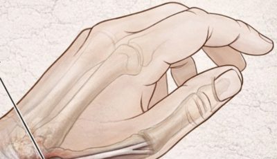 Why Do Your Hands Fall Asleep? Common Causes and Natural Remedies That Actually Work